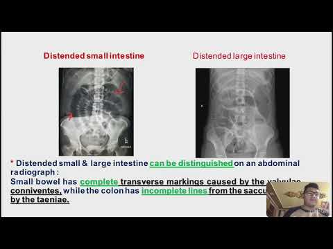 Surgery: large intestine L1