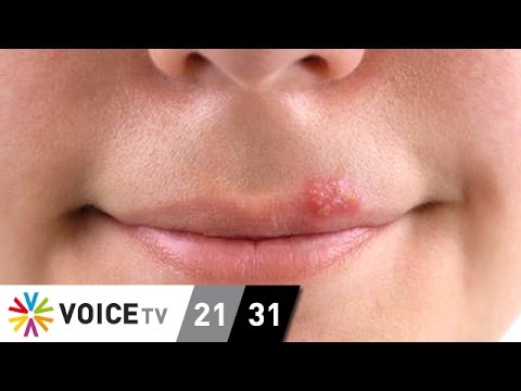 เริมที่ปาก