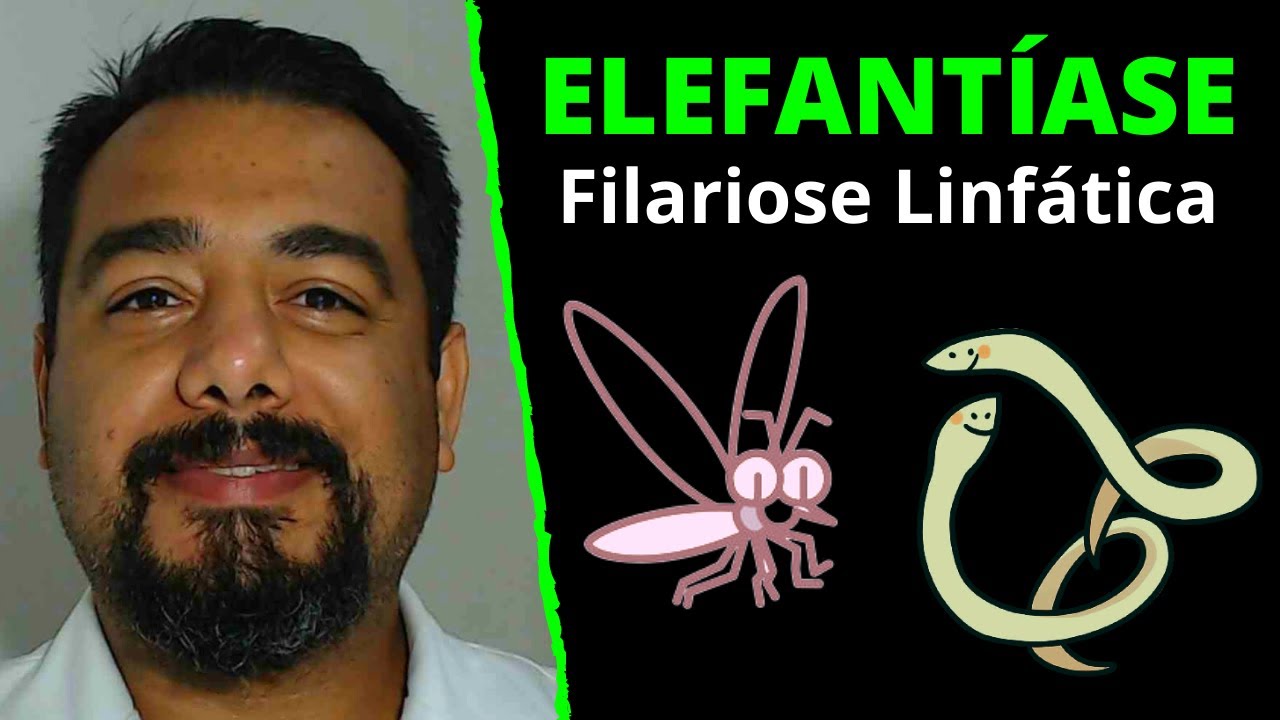 Elefantíase (Filariose Linfática) | Wuchereria bancrofti (Filária) | Curso de Parasitologia Humana