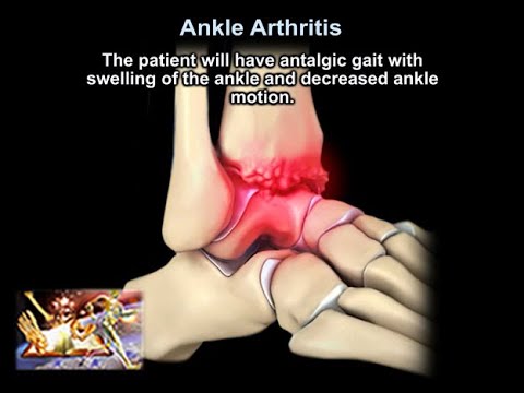 Ankle Arthritis - Everything You Need To Know - Dr. Nabil Ebraheim