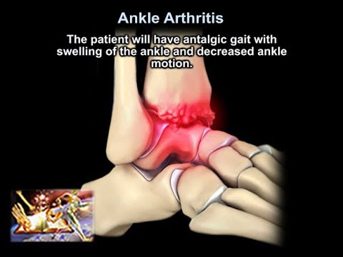 Lézeres hatás az artrózis kezelésében