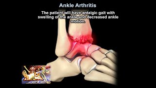 Ankle Arthritis - Everything You Need To Know - Dr. Nabil Ebraheim