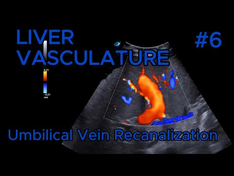 Complete umbilical vein recanalization video preview
