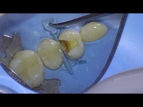 CLASS 2 COMPOSITE RESTORATIONS PERFROMED WITH RUBBER DAM