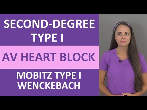 Second-Degree Type I AV Heart Block Nursing NCLEX ECG | Mobitz Type 1 | Wenckebach
