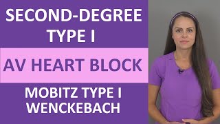 Second-Degree Type I AV Heart Block Nursing NCLEX 