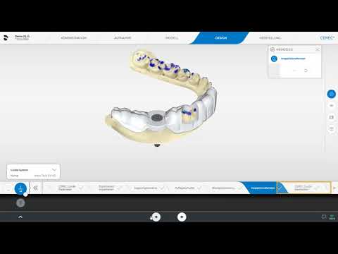 Digitaler Chairside Implantat Workflow Teil 5: Finalisieren