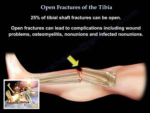 Open Fractures Of The Tibia  - Everything You Need To Know - Dr. Nabil Ebraheim