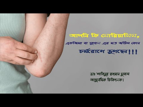 সোরিয়াসিস, একজিমা বা লুপাসের চিকিৎসা