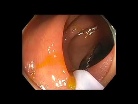 Colonoscopia - resección mucosa endoscópica (RME) de un pólipo del angulo hepático del colon en una ubicación inestable