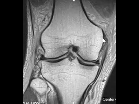 Medial Collateral Ligament Tear