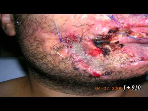 comment soigner une brulure a l'azote