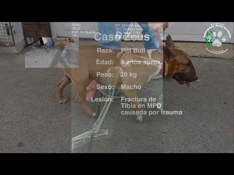 Fractura de Tibia MPD   Caso Zeus