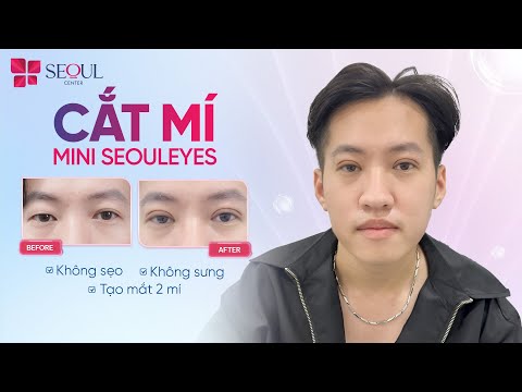 Cắt Mí Nam Chuẩn Hàn Không Sưng Không Để Sẹo