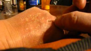 Horsehair Nematomorpha Gordian Worm - Human Strongyloides or THREAD WORM Part 2