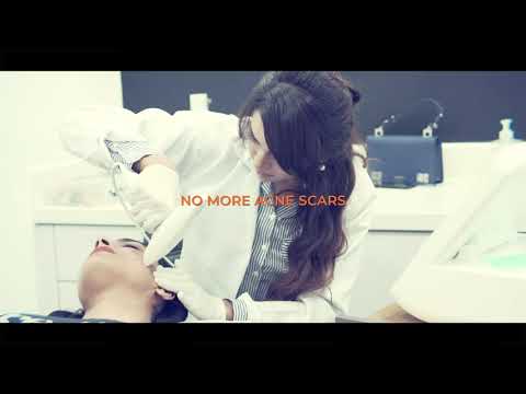 No More Acne Scars | Venus Viva | FDA Approved Treatment