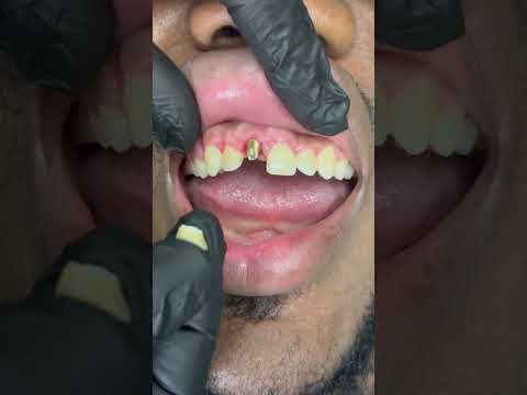 Single front tooth implant ❤️ Now you see it , now you don't!