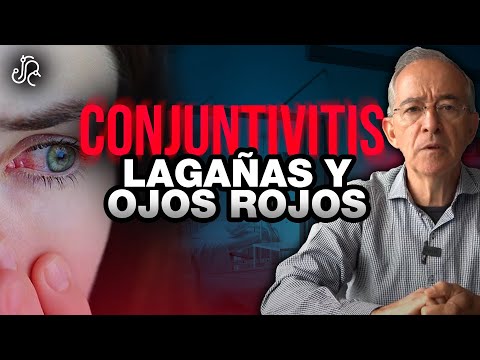 CONJUNTIVITIS Lagañas Y Ojos Rojos - Oswaldo Restrepo RSC