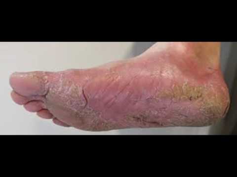 Sviluppo di psoriasi in bambini Cura di psoriasi cryo