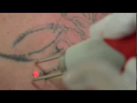 Tattoo Removal Laser Ink Undone Melbourne Mr B