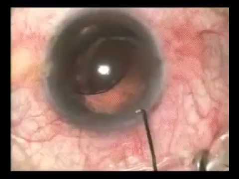 Vid-IC-APAO-In Situ Repositioning of subluxated Lens