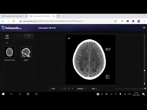 TEAM FRCR 2B Viva Practice Session (CNS Module Revision). 16th Jan, 2021