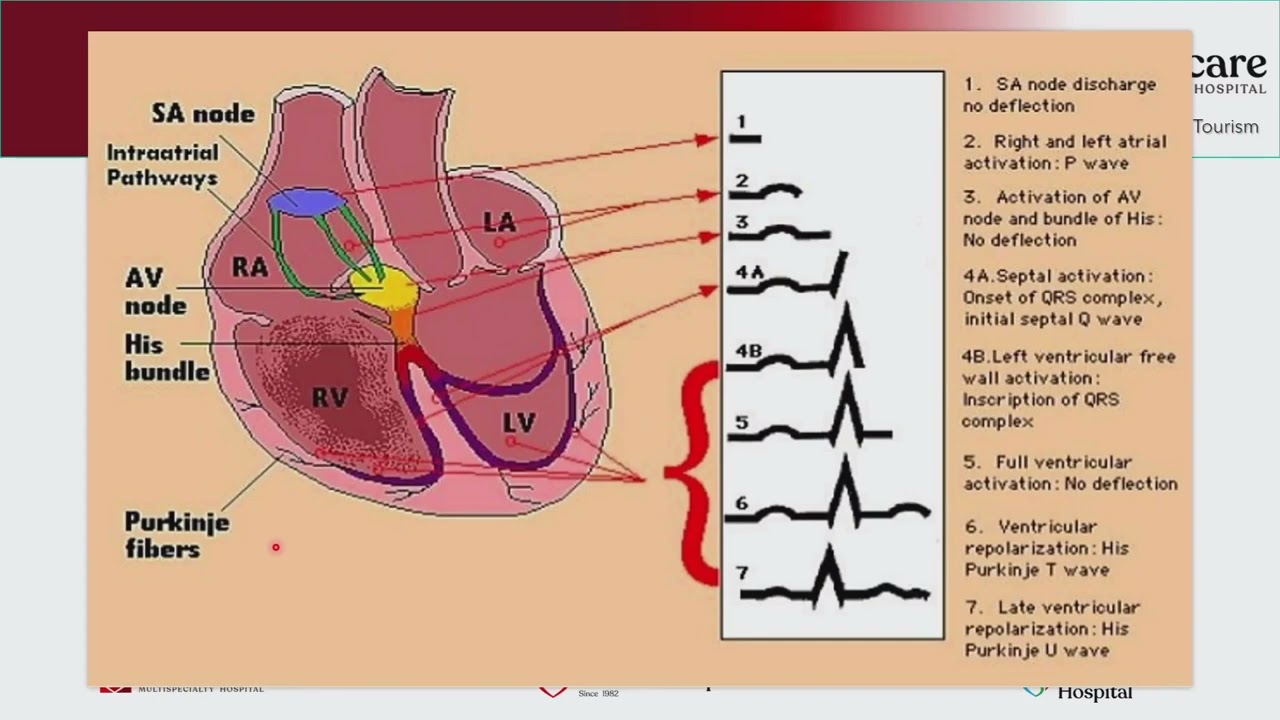 ACS DAY 2 ECG INTERPRETATION BY DR .I. ISEKO