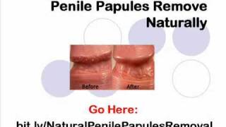 How to Get Rid of Pearly Penile Papules (bumps) in 3 Days!