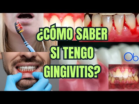 ¿Cómo saber si tengo GINGIVITIS?