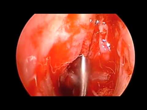 Resection of Haller Cell and Concha Bullosa