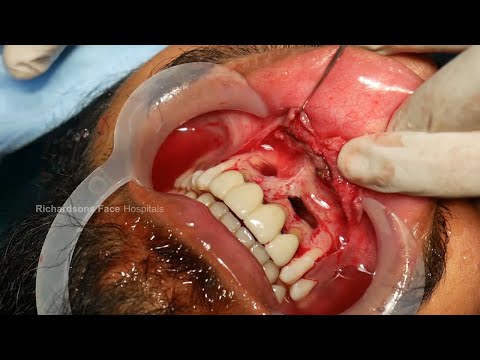 Painful Cyst Removed from Mouth - Surgical Method