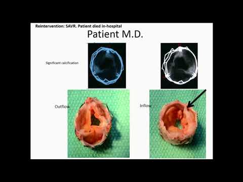Is Durability a Problem for TAVR Valves? - Danny Dvir, MD