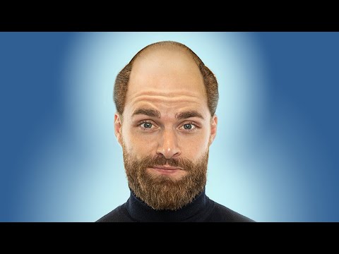 Haarausfall bei Männern! Was ist das?