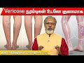உடலில் தோன்றும் Varicose நரம்புகள் மறைய யோ