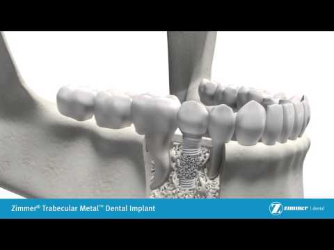 Trabecular Metal Dental Implant