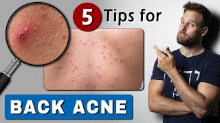 How to GET RID of BACK ACNE  fast & easy!