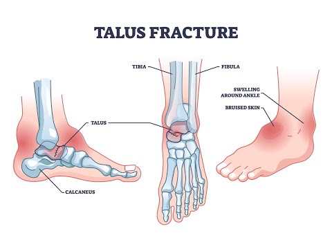 Fracture of the Talus Bone; Definition, approach, Causes, Symptoms, Diagnosis, Treatment