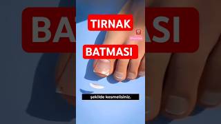 Tırnak Batması - Tırnak Batması Nasıl Önlenir ?
