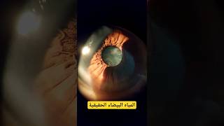 مشاهد حقيقية عن المياه البيضاء في العين العين العيون viral شاهد