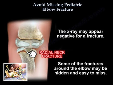 Avoid Missing Pediatric Elbow Fracture - Everything You Need To Know - Dr. Nabil Ebraheim
