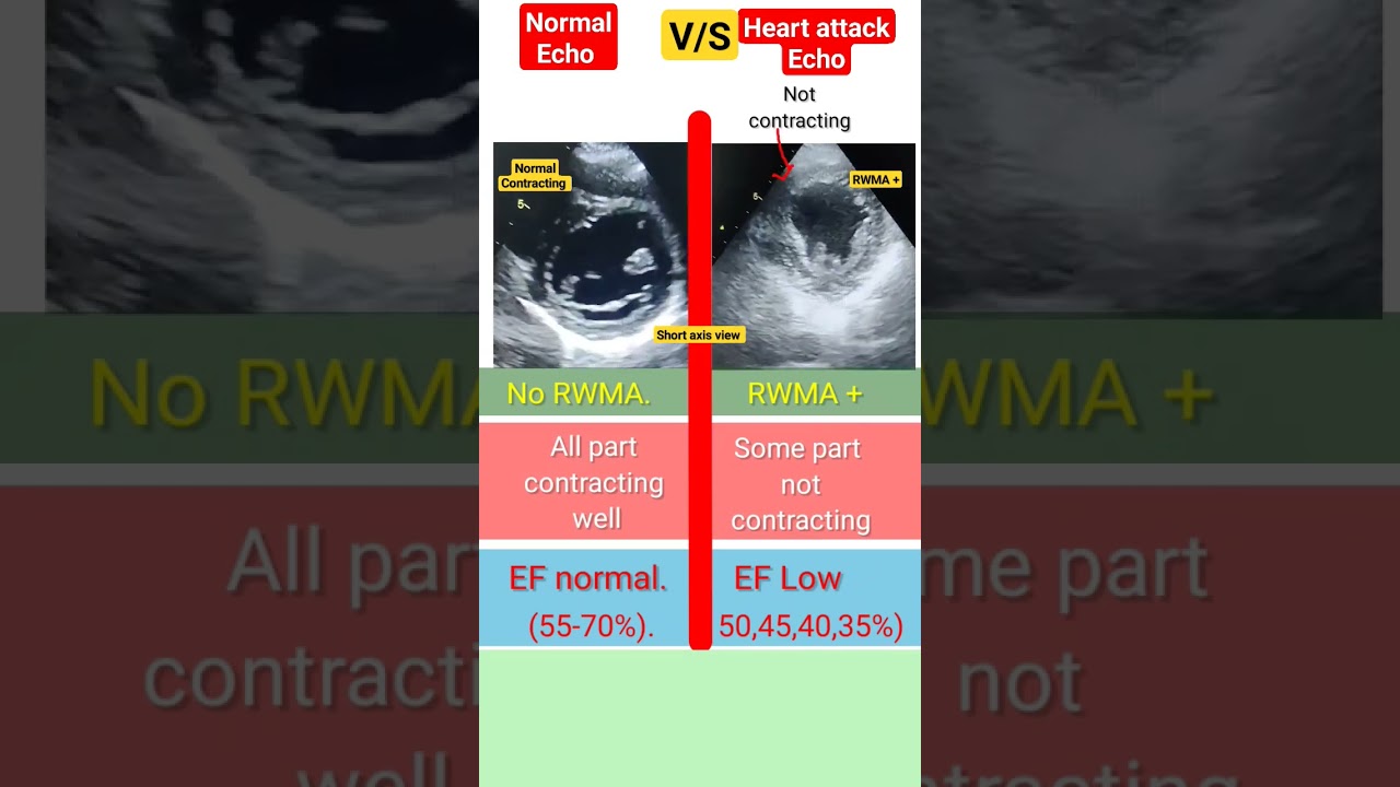 Difference between normal and heart attack Echo #echo #heartattack #shorts