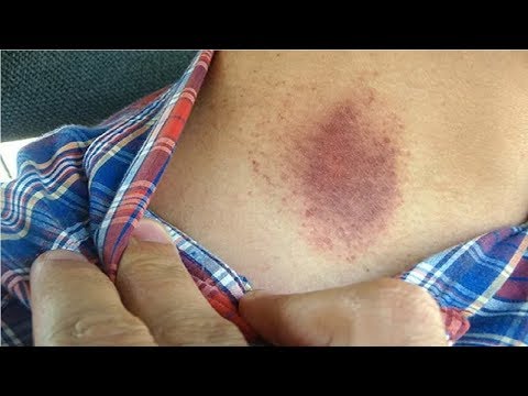 download lagu mp3 mp4 How Do You Get Rid Of A Hickey, download mp3 How Do You Get Rid Of A Hickey free download, download mp3 How Do You Get Rid Of A Hickey
