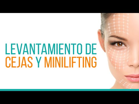 Levantamiento de cejas y Minilifting