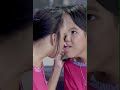 The incredible conjoined twins attached at the head #shorts #ytshorts #conjoinedtwins