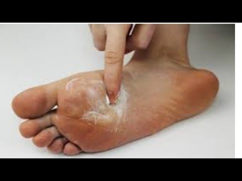 Negii între tratamentul degetelor de la picioare