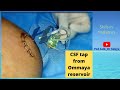 CSF tap procedure from Ommaya reservoir/ Ommaya tap/ decreasing RICT in Hydrocephalus