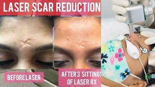 📍 Laser scar reduction #shorts