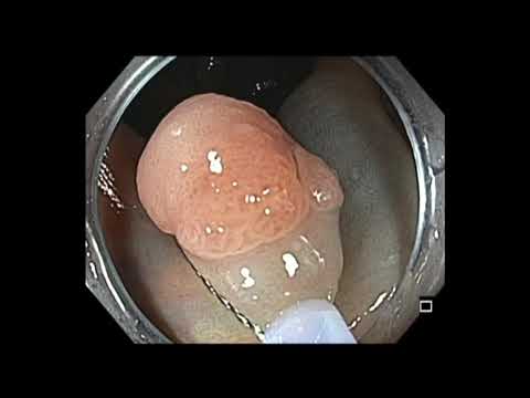 Colonoscopia - resección mucosa endoscópica (RME) de un pólipo de la válvula ileocecal