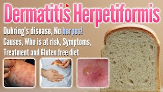 Dermatitis herpetiformis Causes, Symptoms, Treatment and gluten-free diet list | Duhring’s disease