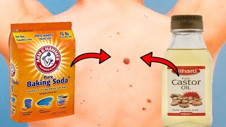 Get Rid of Warts, Moles, and Skin Tags with Castor Oil and Baking Soda